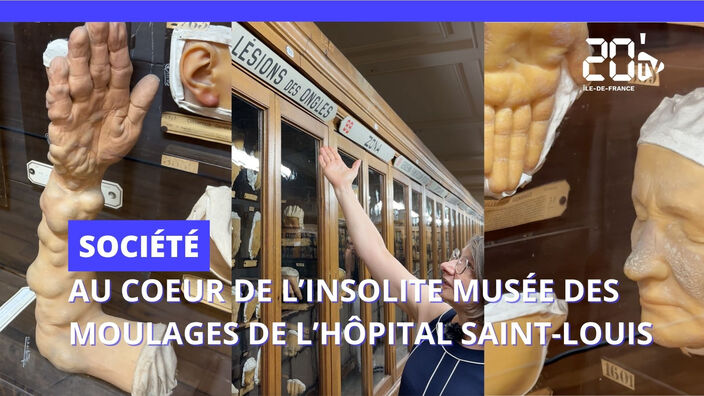 Au coeur de l'insolite musée des moulages de l'hôpital Saint-Louis